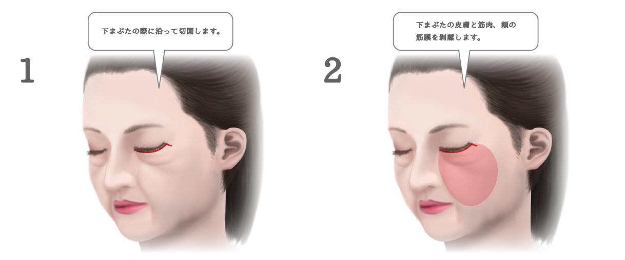 ミッドフェイスリフトの手術方法
