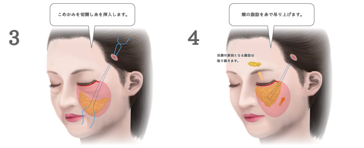 ミッドフェイスリフトの手術方法