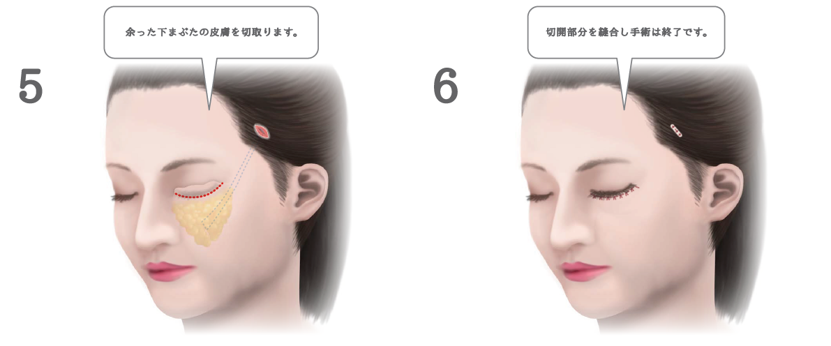 ミッドフェイスリフトの手術方法
