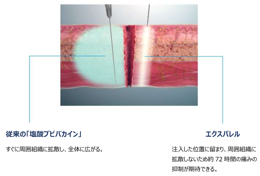 エクスパレル麻酔
