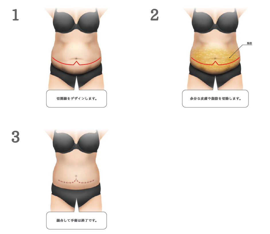 腹部リダクション
