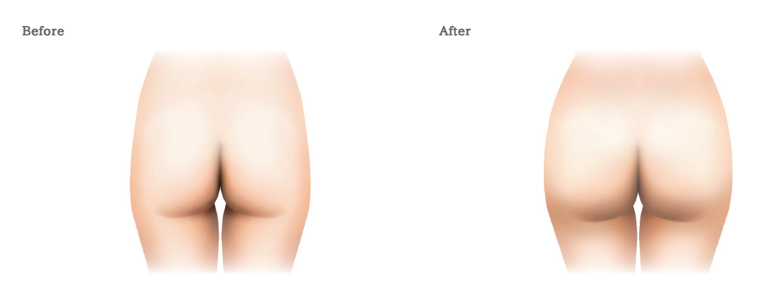 臀部（ヒップ）プロテーゼ挿入