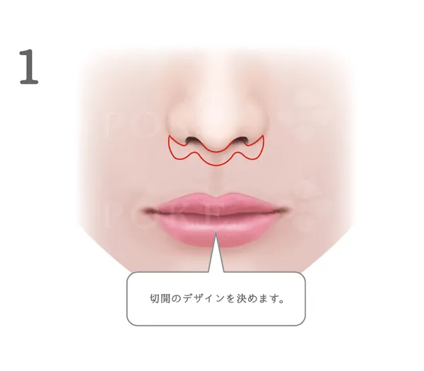 上口唇短縮術(人中短縮術)の手術説明