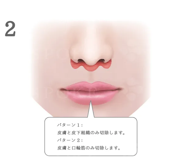 上口唇短縮術(人中短縮術)の手術説明
