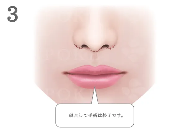 上口唇短縮術(人中短縮術)の手術説明