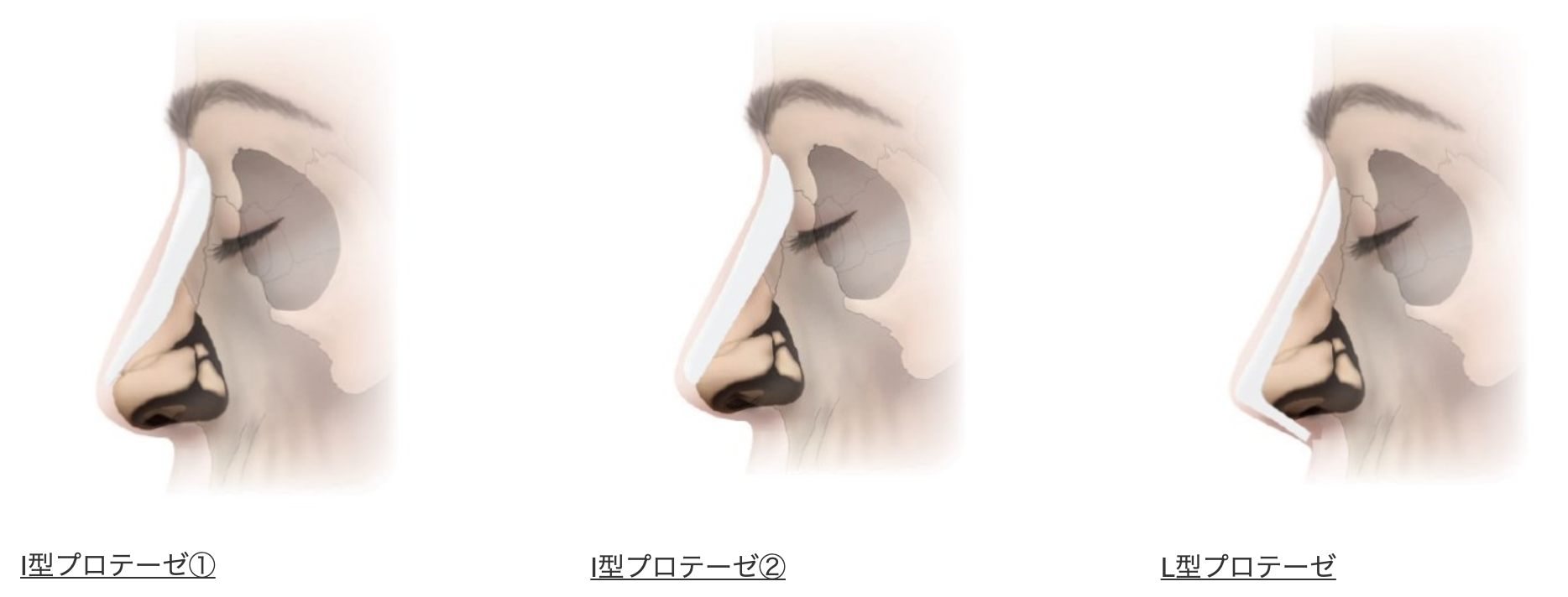 隆鼻術_シリコンプロテーゼの種類