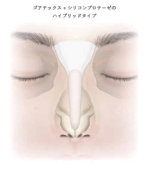 眉間プロテーゼ挿入術_図解