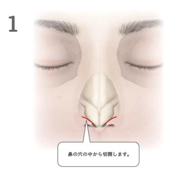 眉間プロテーゼ挿入術_図解