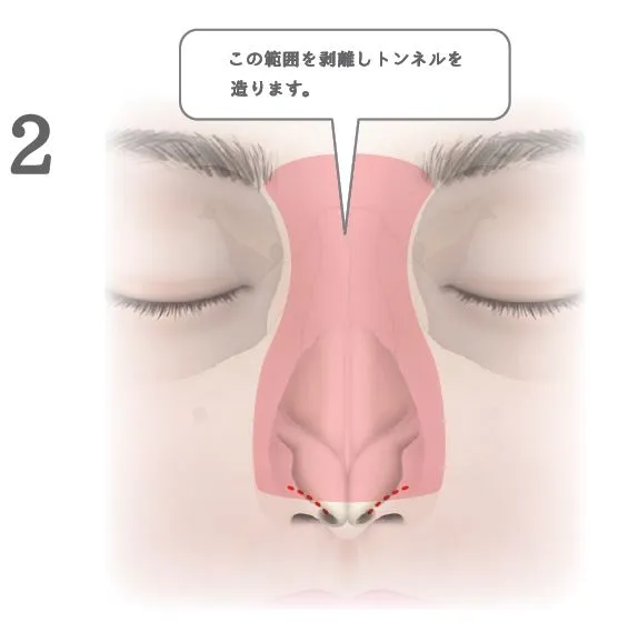 眉間プロテーゼ挿入術_図解