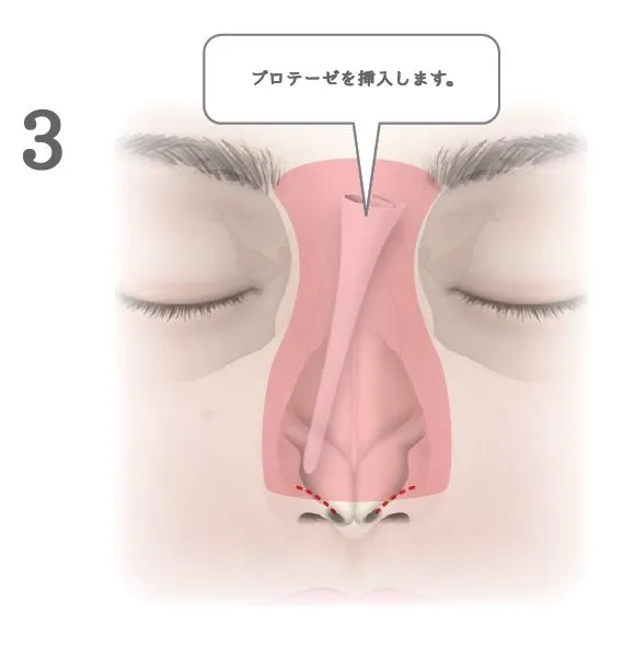 眉間プロテーゼ挿入術_図解