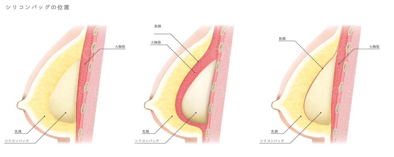 豊胸術（シリコンバック）