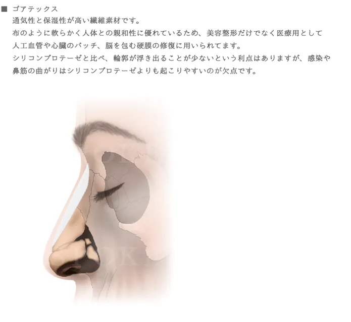 隆鼻術イラスト_ゴアテックス