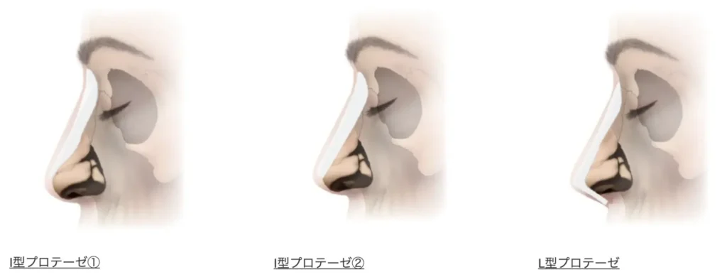 隆鼻術イラスト_プロテーゼの形