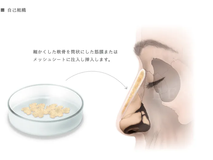 隆鼻術イラスト_自家組織