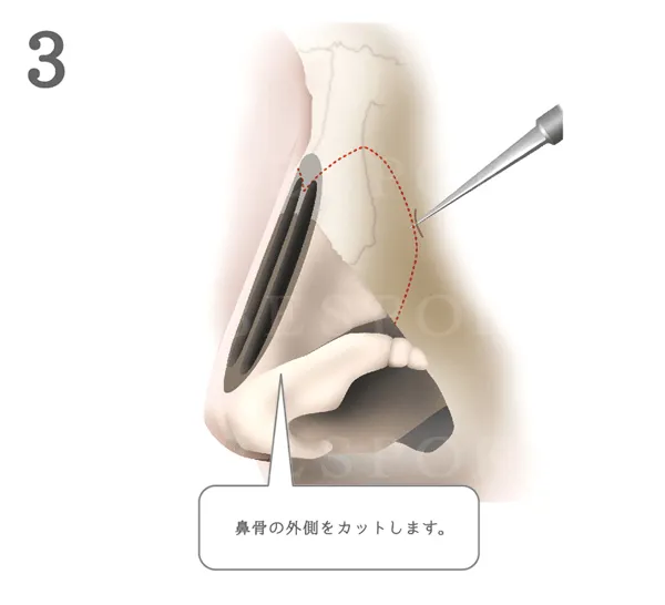 鷲鼻_図解