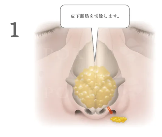 鼻尖縮小術の流れ