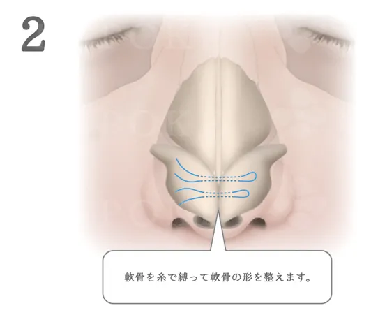 鼻尖縮小術の流れ