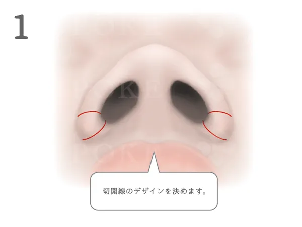 鼻翼縮小術_図式