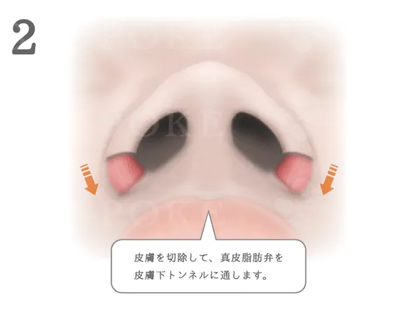 鼻翼縮小術_図式