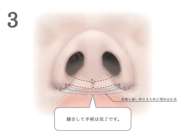 鼻翼縮小術_図式