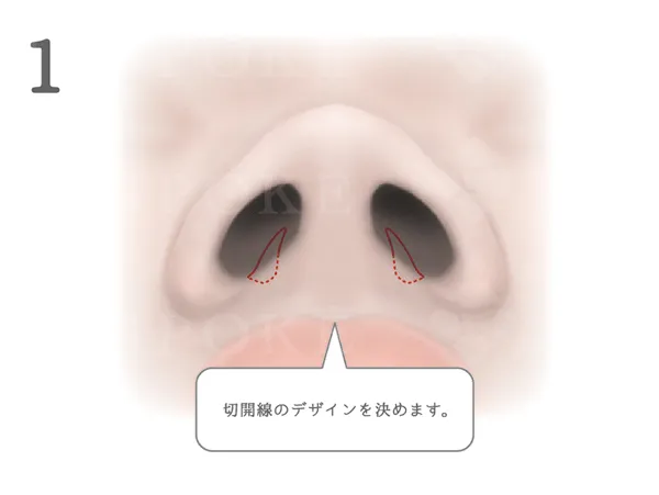 鼻翼縮小術_図式
