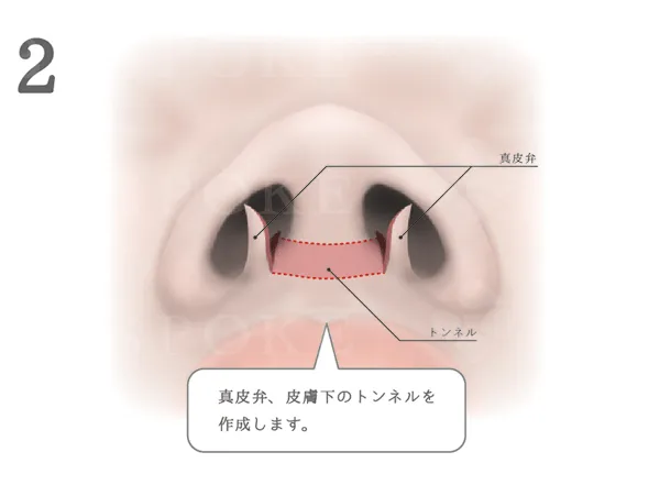 鼻翼縮小術_図式