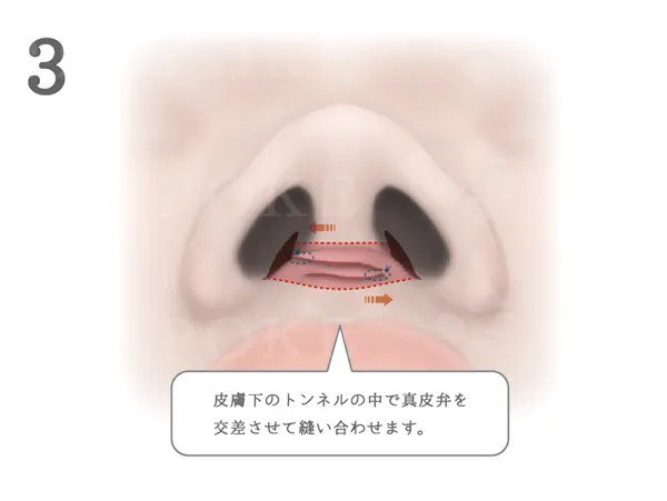 鼻翼縮小術_図式