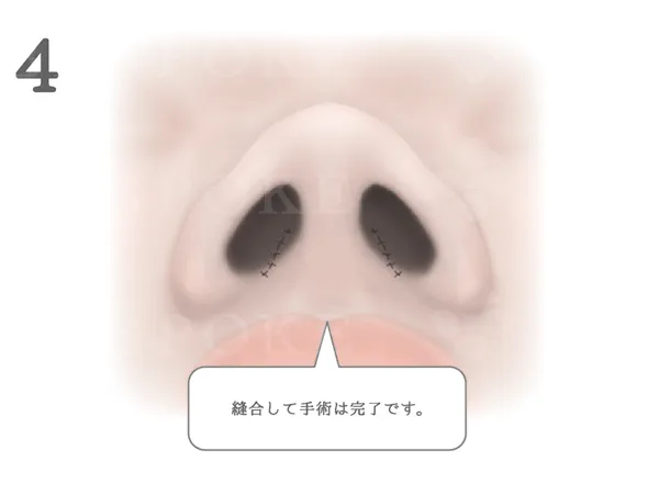 鼻翼縮小術_図式