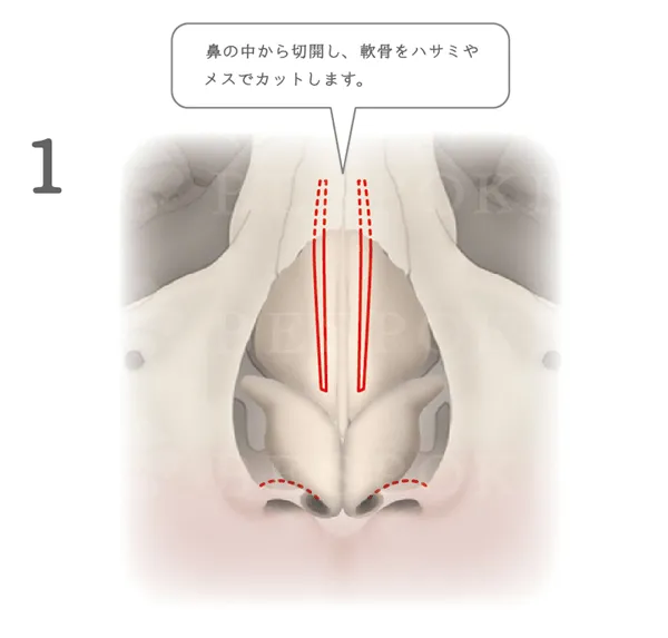 鼻骨骨切り幅寄せ術_図解