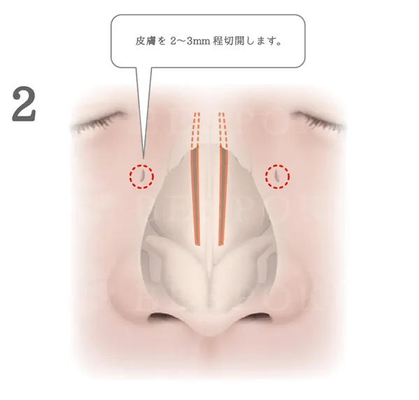 鼻骨骨切り幅寄せ術_図解