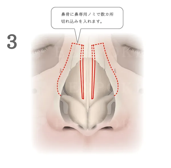 鼻骨骨切り幅寄せ術_図解
