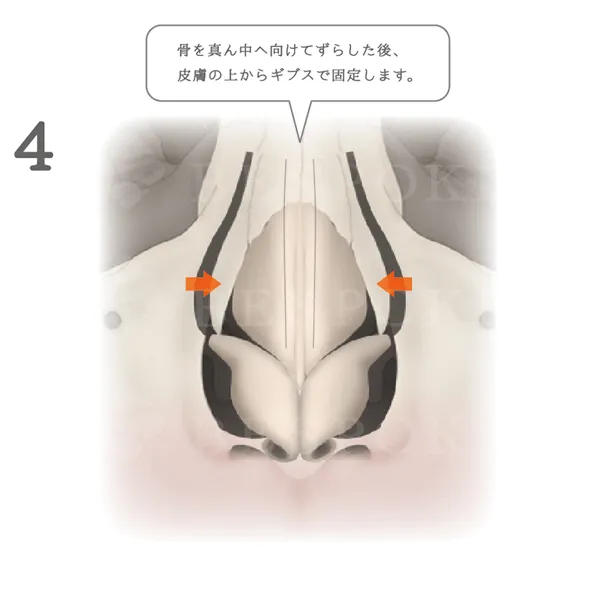鼻骨骨切り幅寄せ術_図解