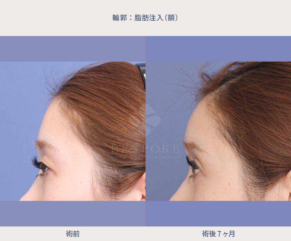 額への脂肪注入の術前術後の右側面写真
