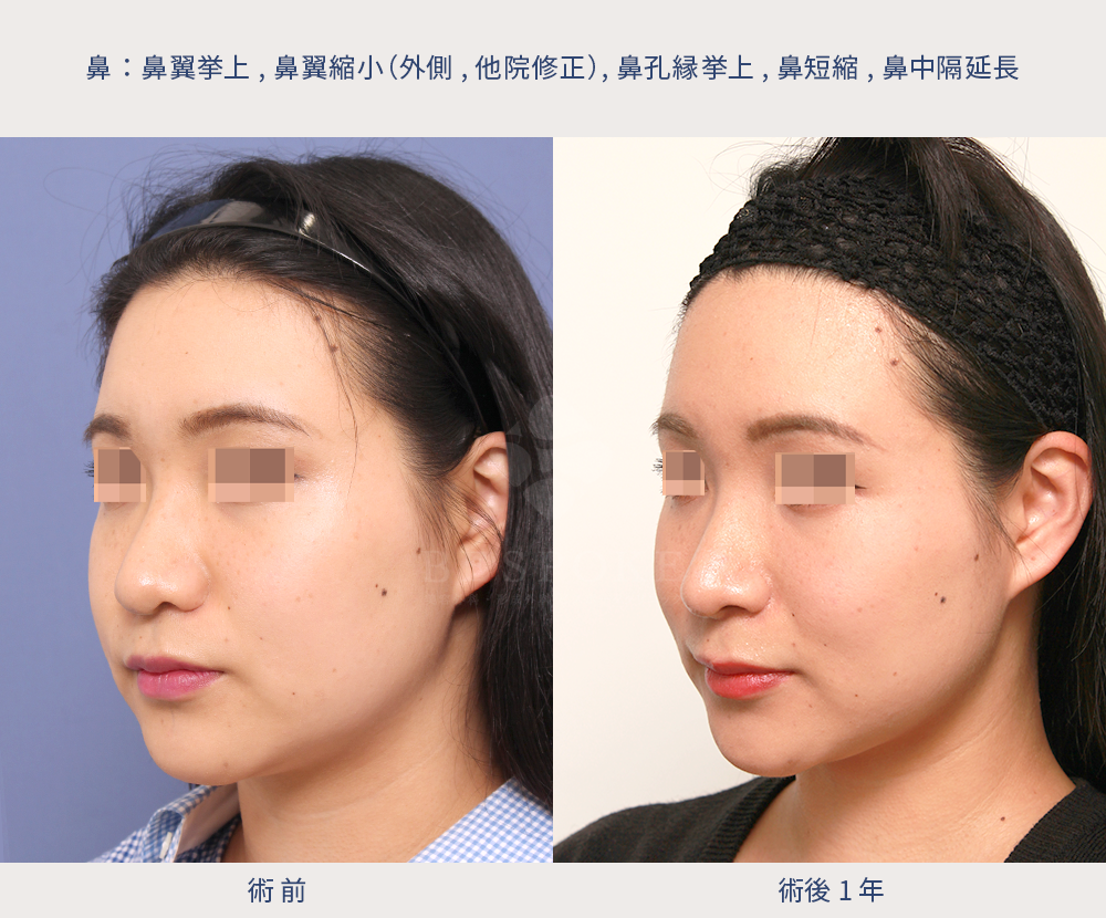 鼻翼縮小（フェイスラインに合わせた小鼻へ）の術前術後の左斜写真