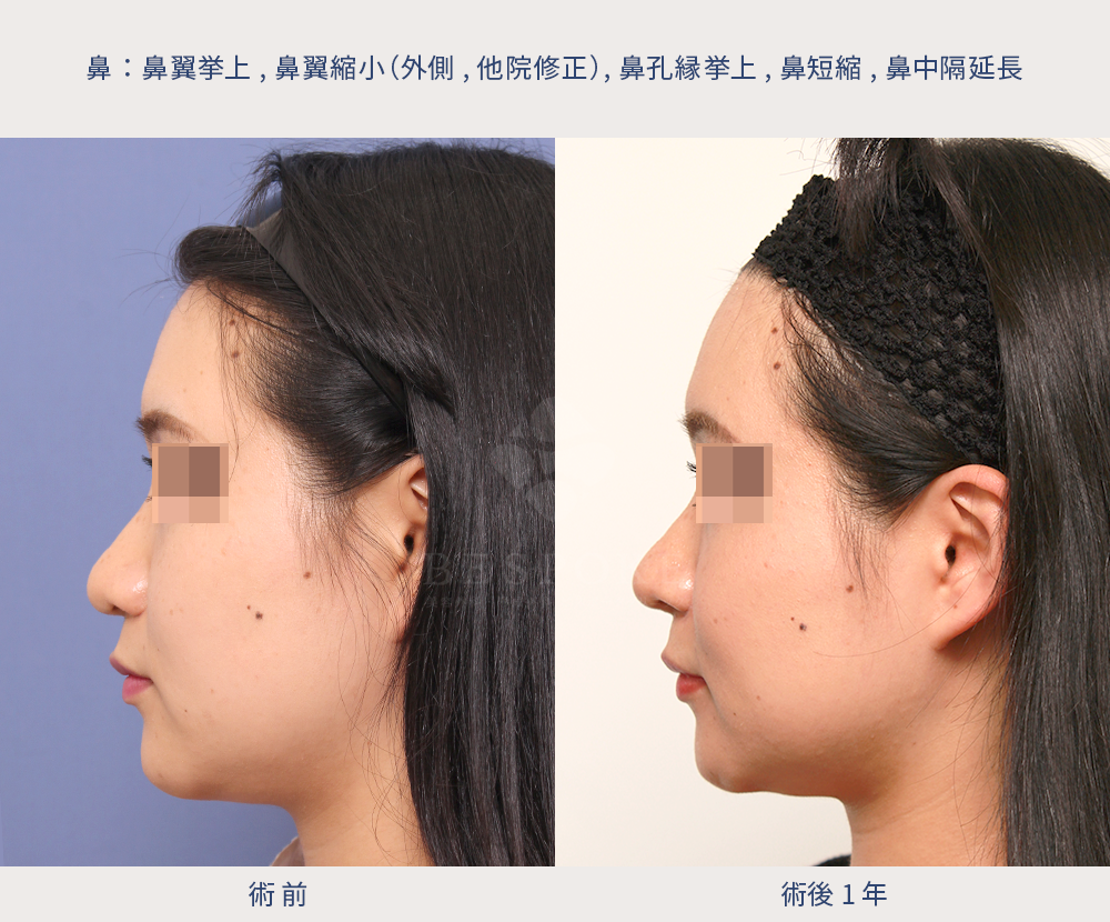 鼻翼縮小（フェイスラインに合わせた小鼻へ）の術前術後の右側面写真