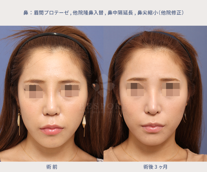 他院修正（顔の形状に合わせたマイルドなワシ鼻へ）の術前術後の正面写真