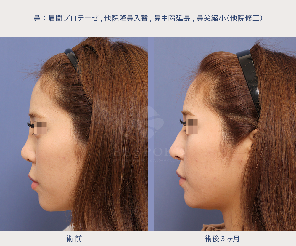 他院修正（顔の形状に合わせたマイルドなワシ鼻へ）の術前術後の右側面写真