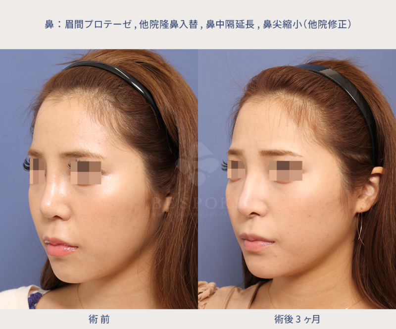 他院修正（顔の形状に合わせたマイルドなワシ鼻へ）の術前術後の左斜写真