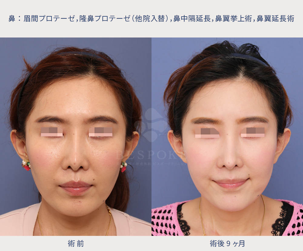 L型プロテーゼの他院修正の術前術後の正面写真