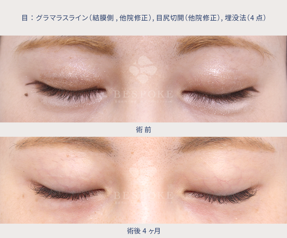グラマラスライン・目尻切開(他院修正)・埋没 目尻切開とたれ目形成術の他院修正 術前術後の閉眼写真