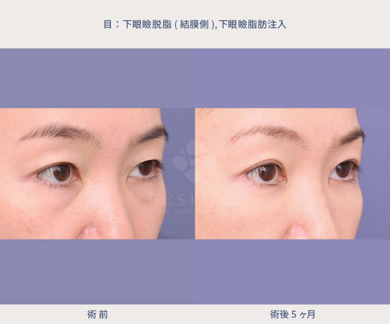 下まぶたへの脂肪注入の術前術後の右斜写真