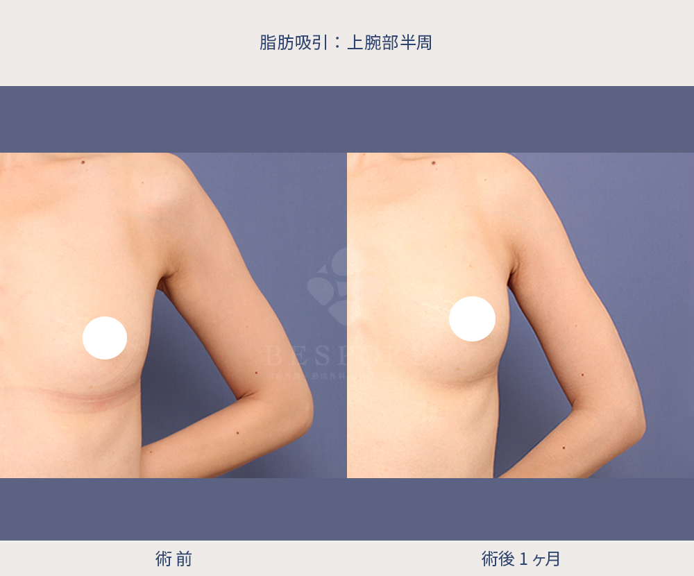 脂肪吸入_二の腕周辺