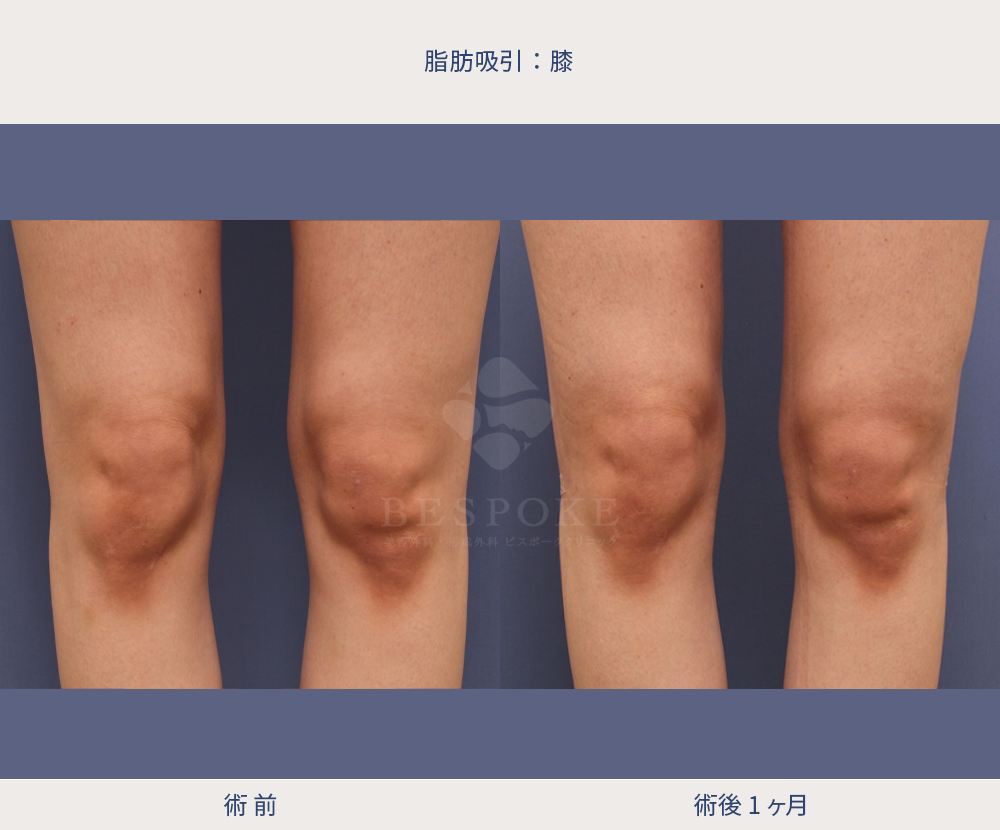 下半身_脂肪吸入_膝周辺
