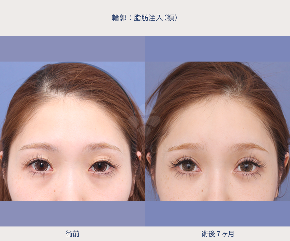 額への脂肪注入の術前術後の正面写真