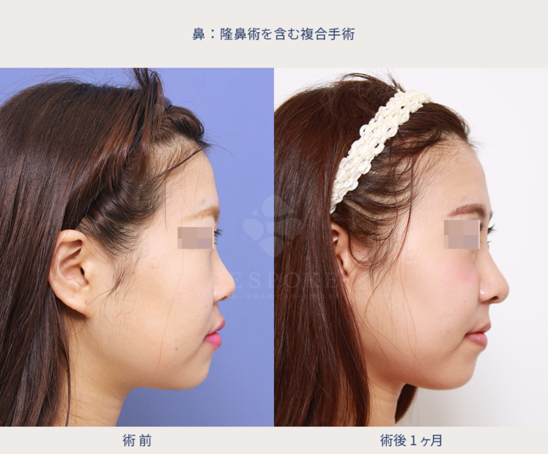 鼻翼縮小（立体感のある顔立ちへ）の術前術後の右側面写真