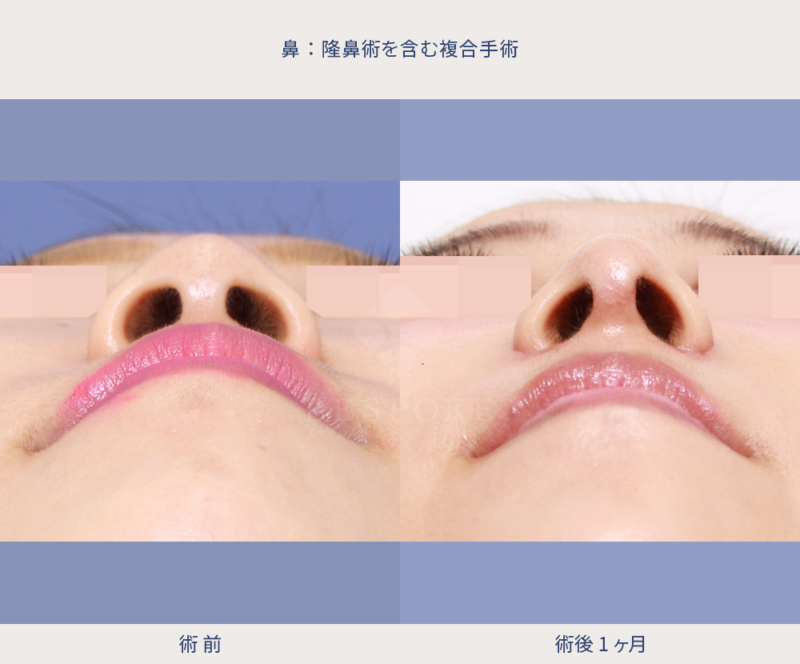 鼻翼縮小（立体感のある顔立ちへ）の術前術後の下側写真