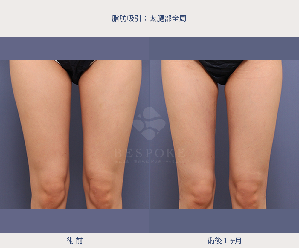 下半身_脂肪吸入_太腿周辺