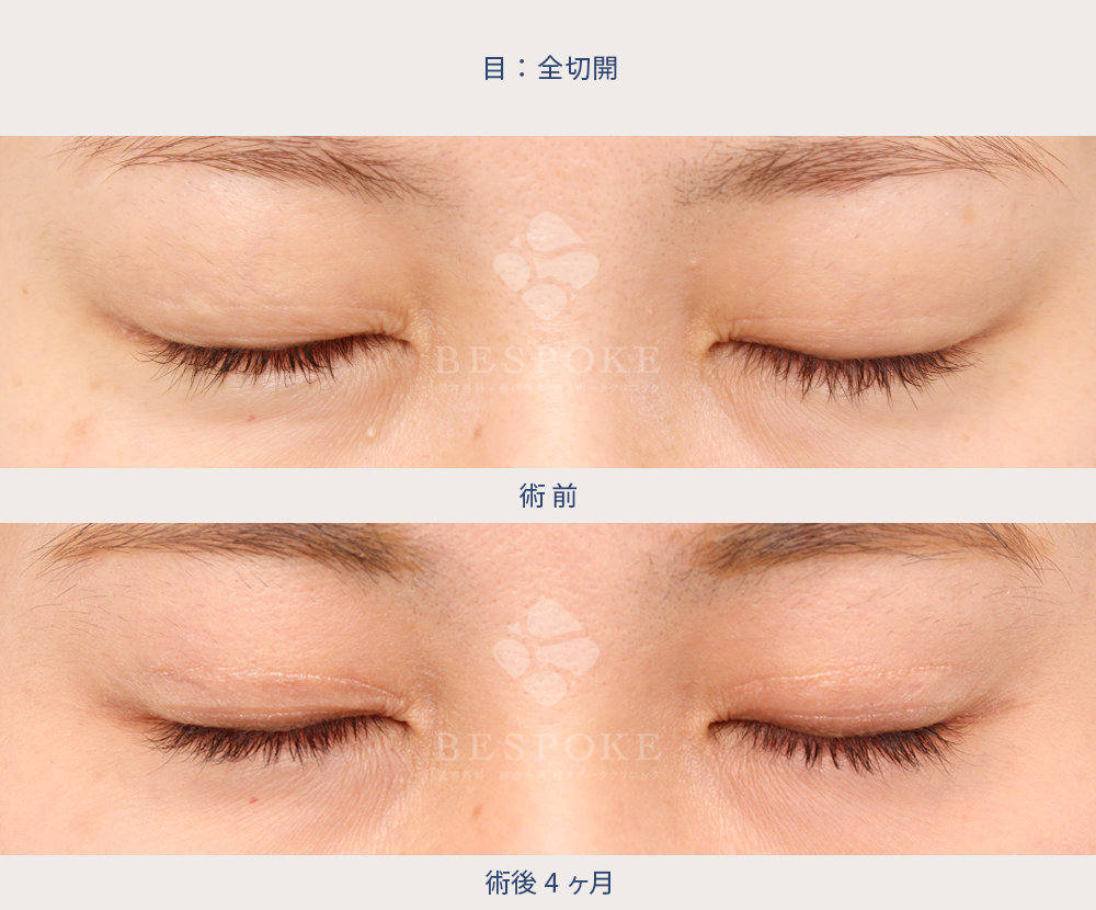 全切開の術前術後写真（閉眼）