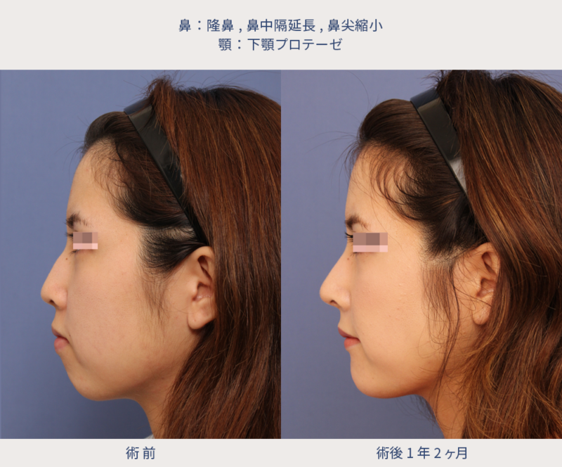隆鼻、鼻中隔延長、鼻尖縮小、下顎プロテーゼの術前術後写真（左横顔）