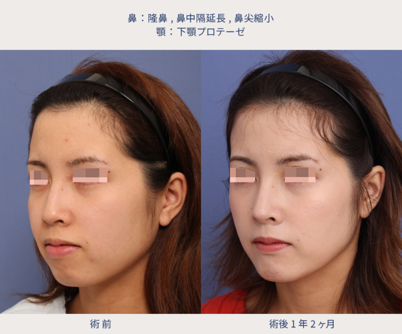 隆鼻、鼻中隔延長、鼻尖縮小、下顎プロテーゼの術前術後写真（左斜）